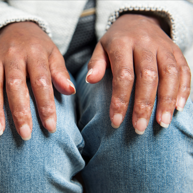 CE - Conoce la esclerodermia | Síntomas de la esclerodermia